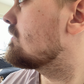 Minoxidil Skägg - Minoxidil Skägg Före Efter