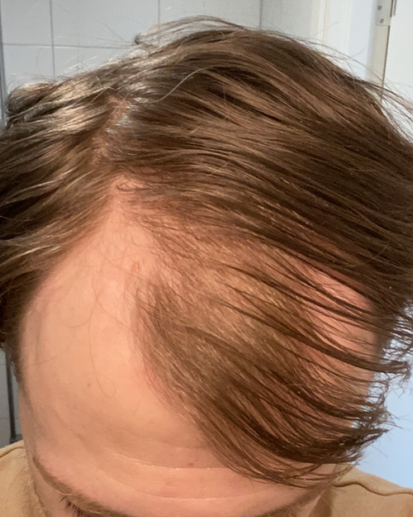 Minoxidil för hårväxt: Före och efter resultat